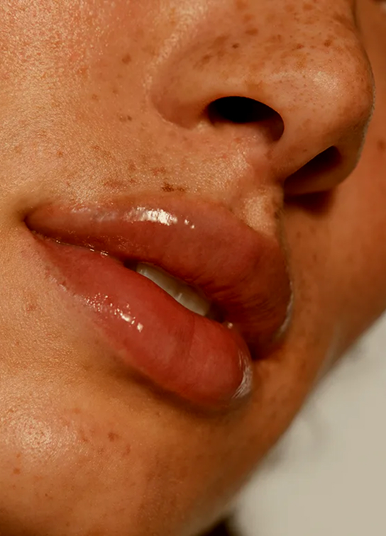 Lip Fillers Aftercare Recovery Img